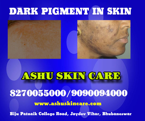 best dark pigment treatment clinic in bhubaneswar near apollo hospital